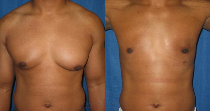 Before & After Male Breast Reduction Case 153 View #3 View in Houston, TX