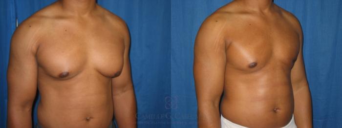 Before & After Male Breast Reduction Case 153 View #4 View in Houston, TX