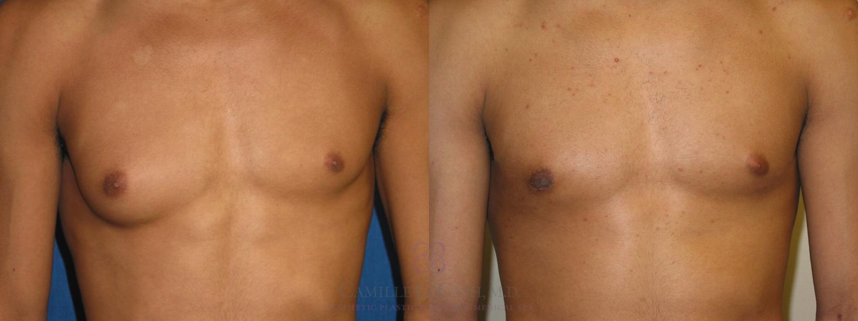 Before & After Male Breast Reduction Case 156 View #1 View in Houston, TX