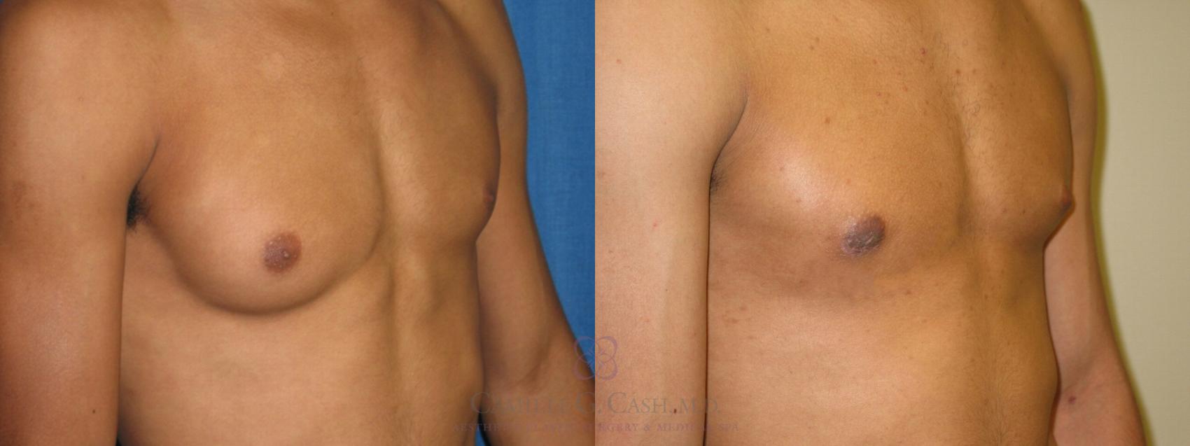 Before & After Male Breast Reduction Case 156 View #2 View in Houston, TX