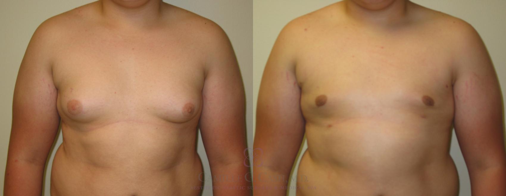 Before & After Male Breast Reduction Case 199 View #1 View in Houston, TX