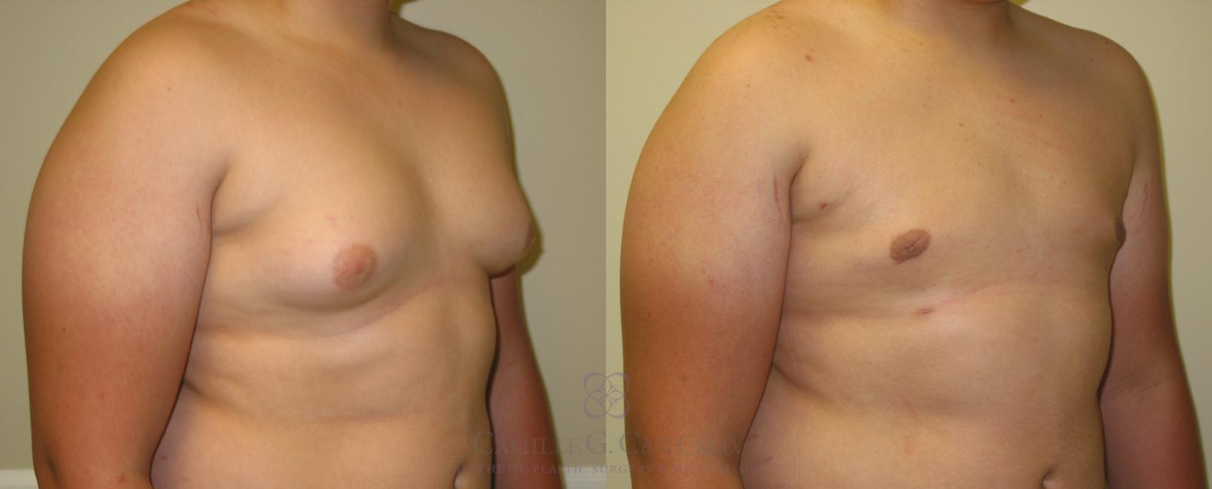 Before & After Male Breast Reduction Case 199 View #2 View in Houston, TX