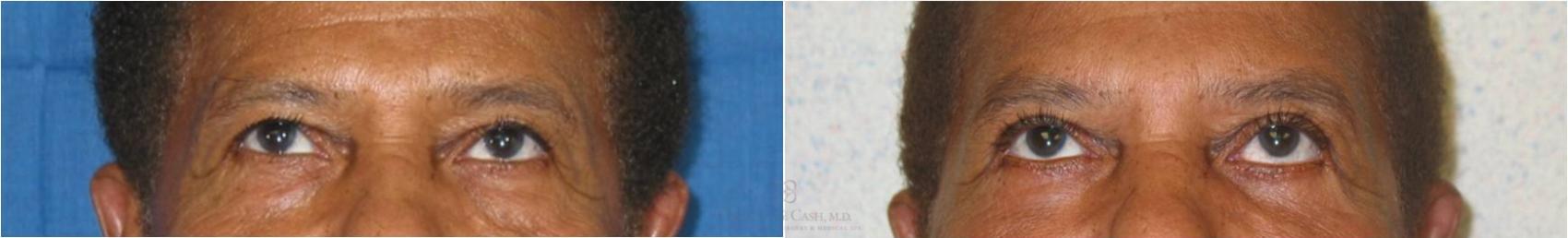 Before & After Male Facial Enhancement Case 29 View #2 View in Houston, TX