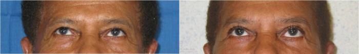 Before & After Male Facial Enhancement Case 29 View #2 View in Houston, TX