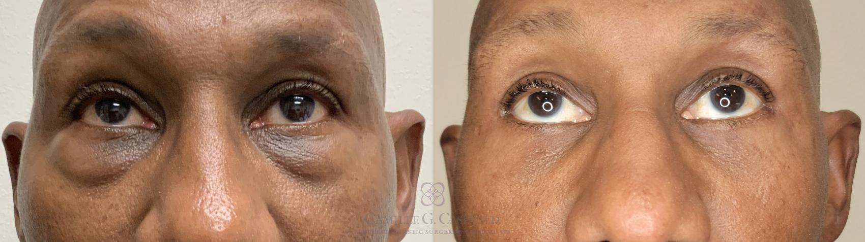 Before & After Male Facial Enhancement Case 662 front looking up 2 View in Houston, TX