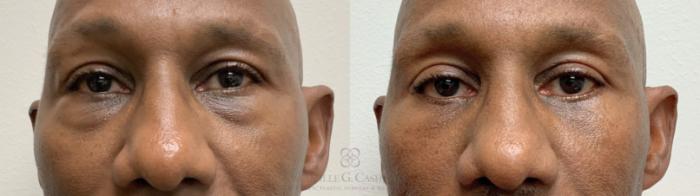 Before & After Male Facial Enhancement Case 662 Front View in Houston, TX