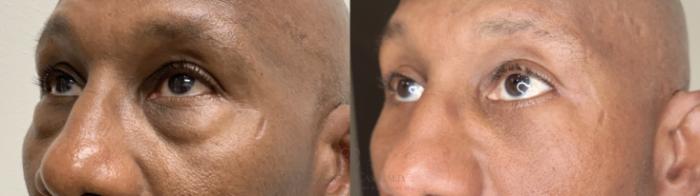 Before & After Eyelid Surgery Case 662 left ob looking up View in Houston, TX