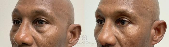 Before & After Eyelid Surgery Case 662 Left Oblique View in Houston, TX
