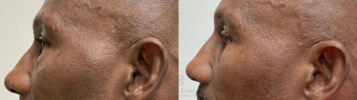 Before & After Eyelid Surgery Case 662 Left Side View in Houston, TX