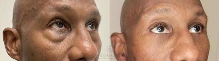 Before & After Eyelid Surgery Case 662 right ob 2 View in Houston, TX