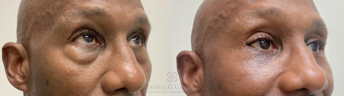 Before & After Eyelid Surgery Case 662 Right Oblique View in Houston, TX