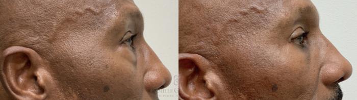 Before & After Eyelid Surgery Case 662 Right Side View in Houston, TX