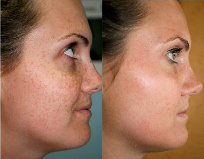 Before & After Melanage Peel Case 367 View #1 View in Houston, TX