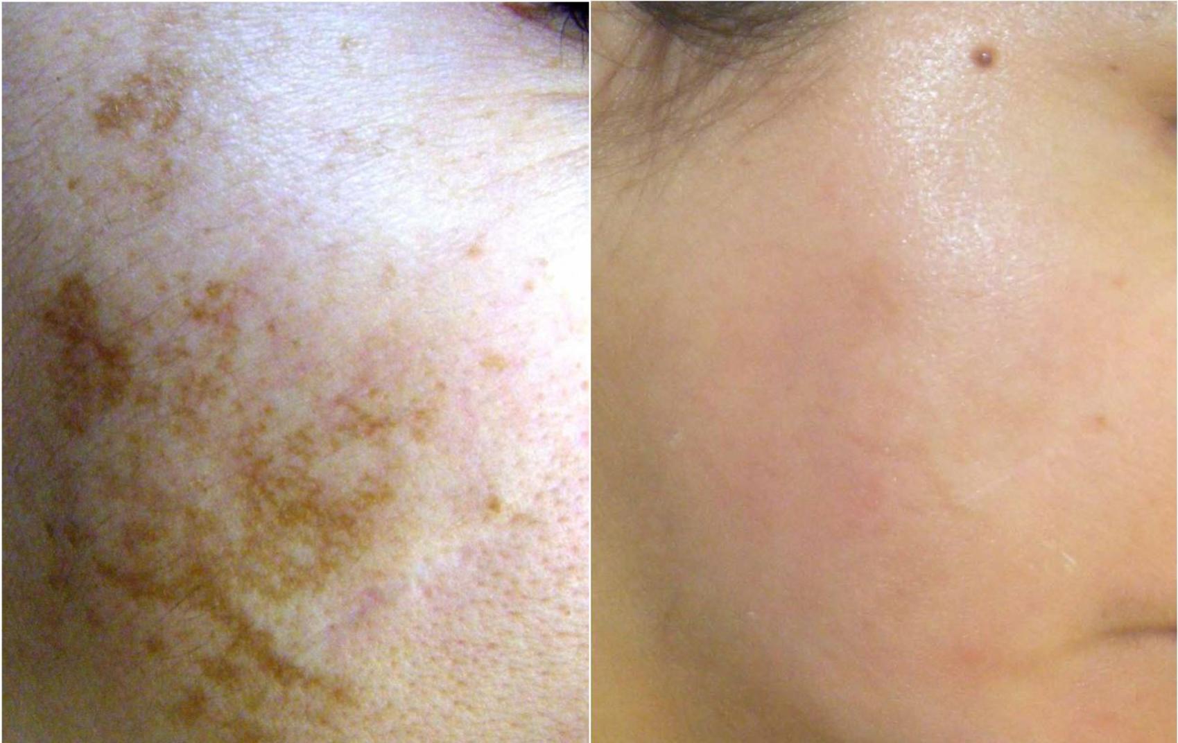 Before & After Melanage Peel Case 368 View #1 View in Houston, TX