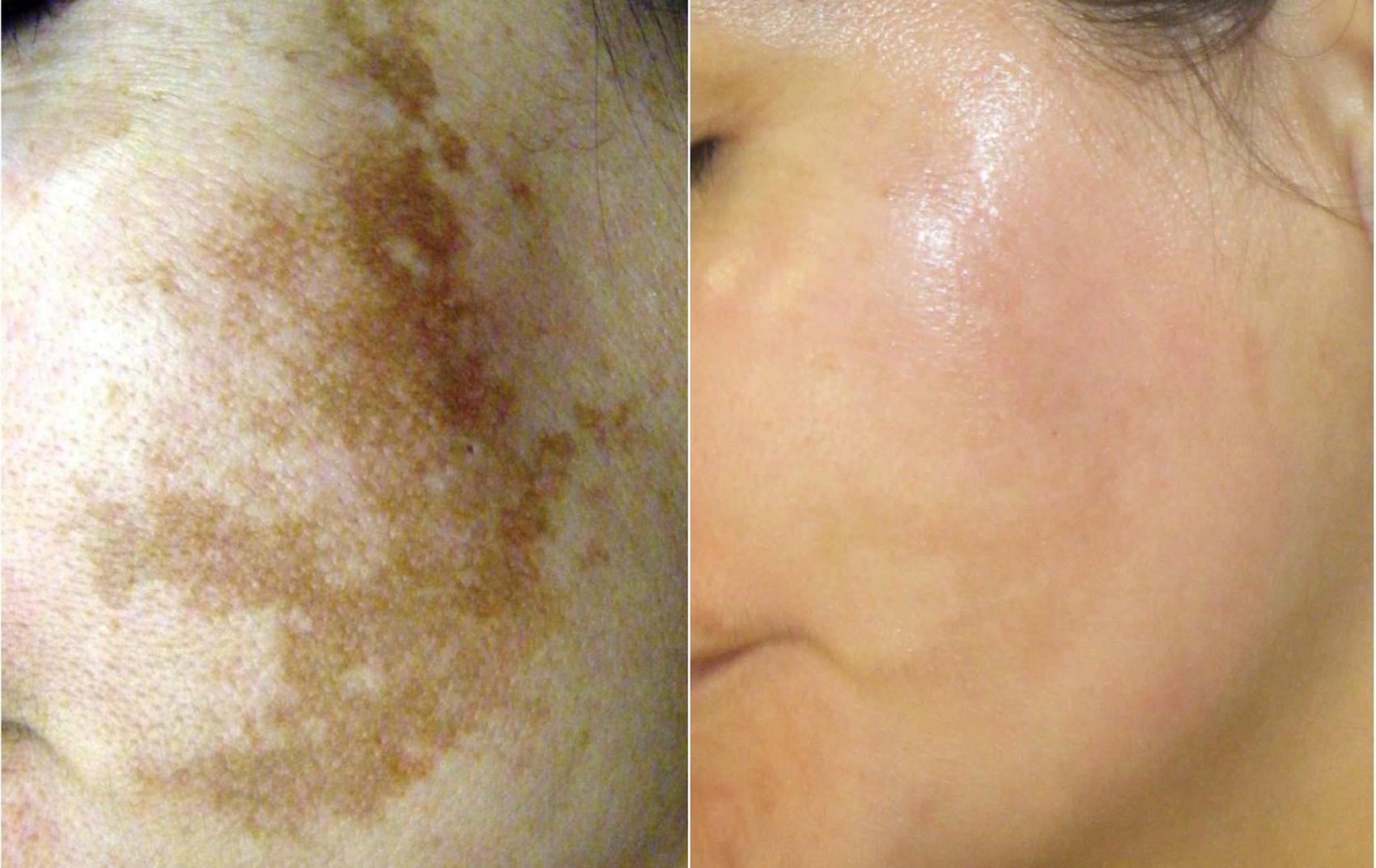 Before & After Melanage Peel Case 368 View #2 View in Houston, TX