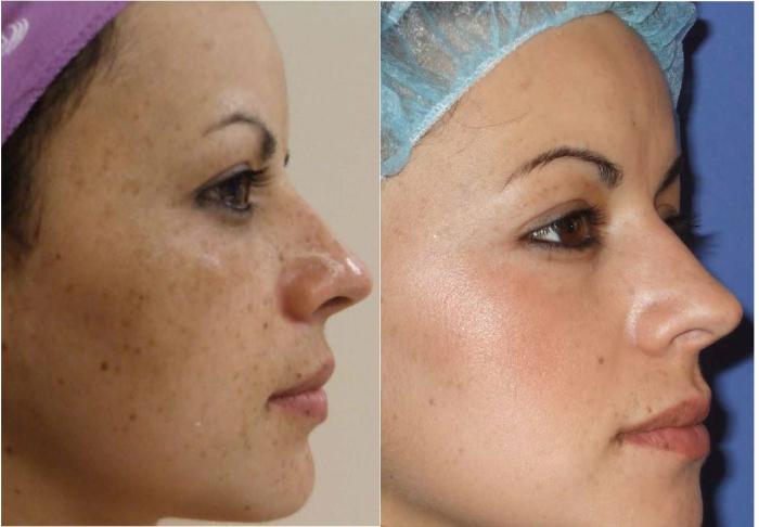 Before & After Melanage Peel Case 369 View #1 View in Houston, TX
