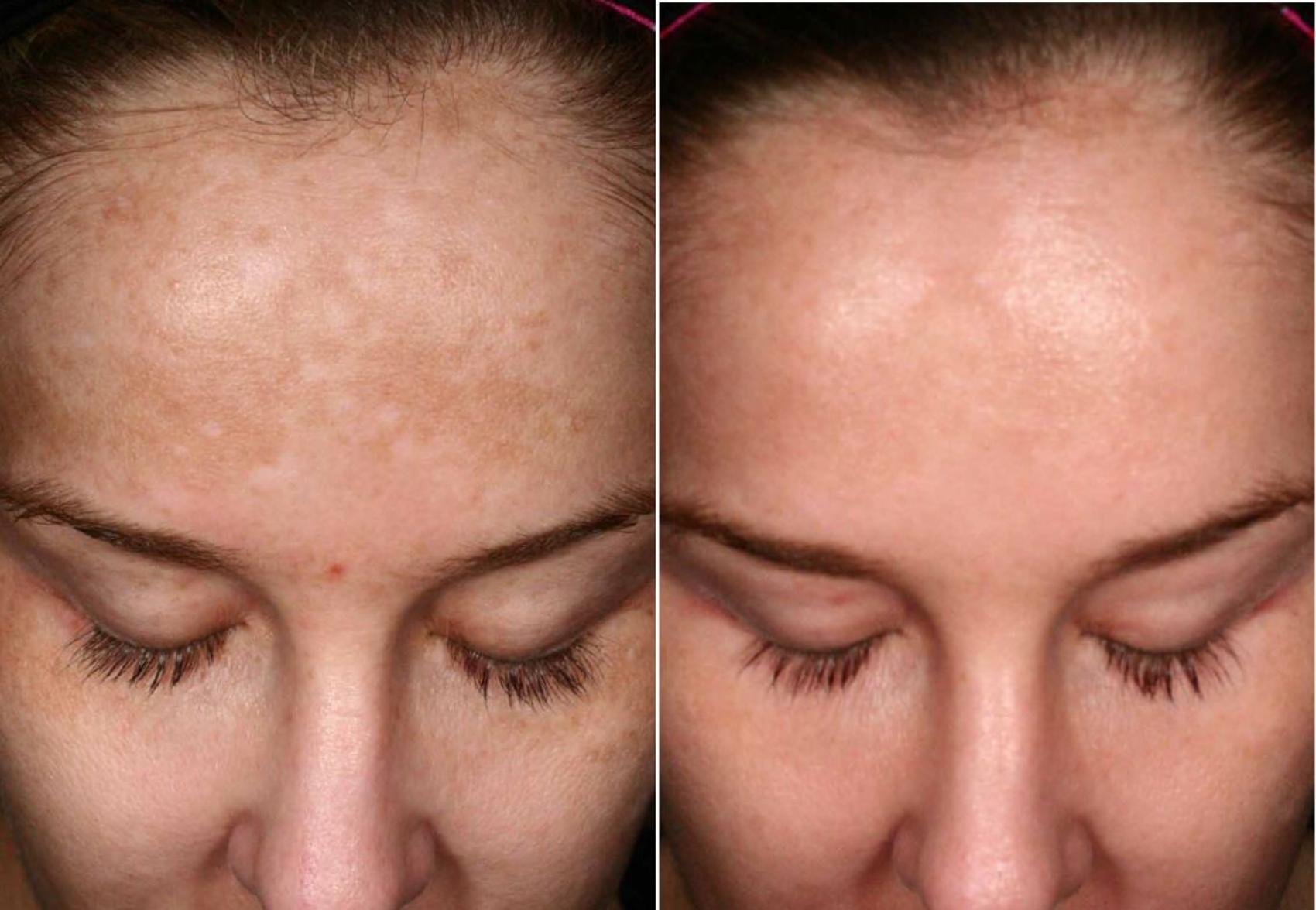 Before & After Melanage Peel Case 370 View #1 View in Houston, TX