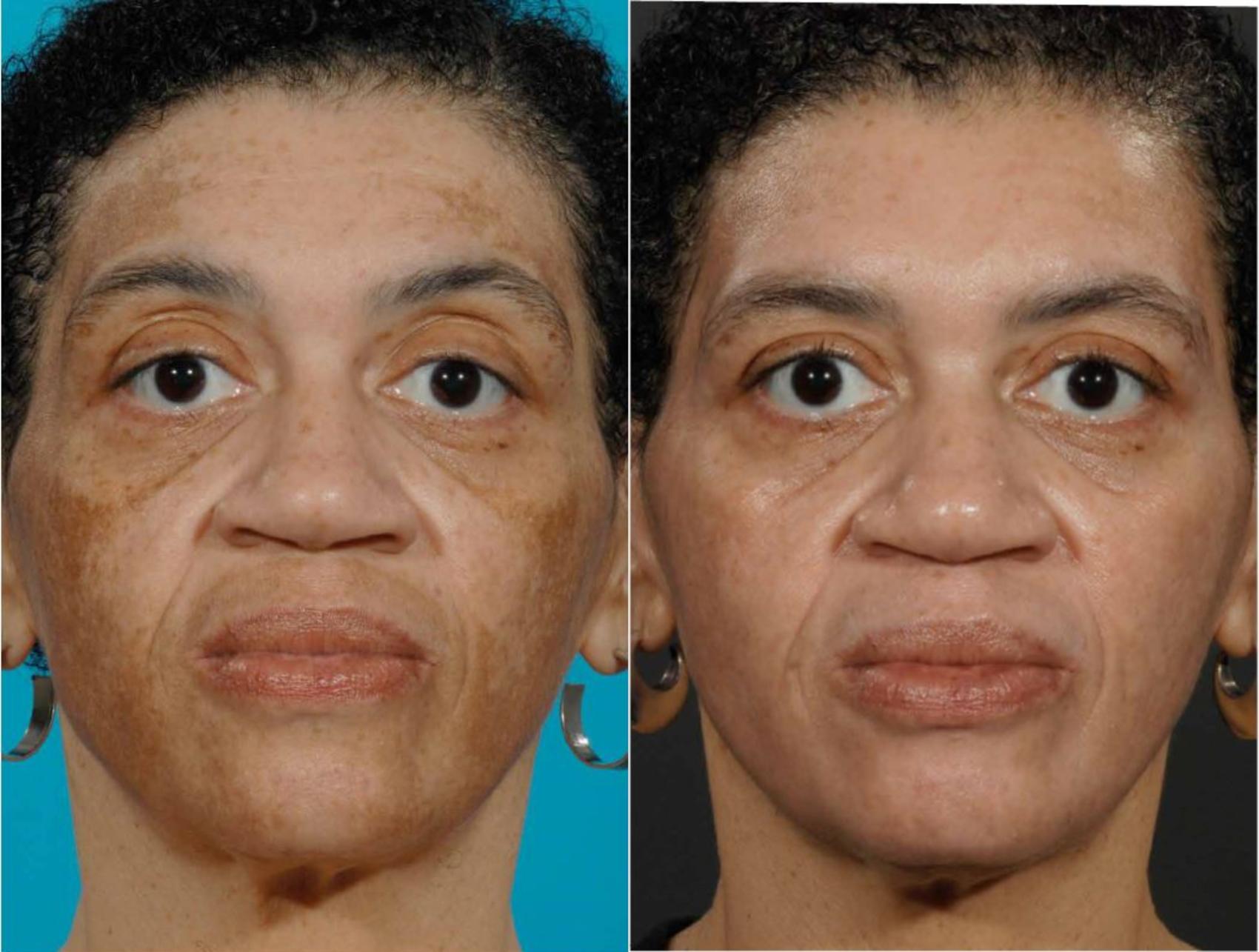Before & After Melanage Peel Case 371 View #1 View in Houston, TX