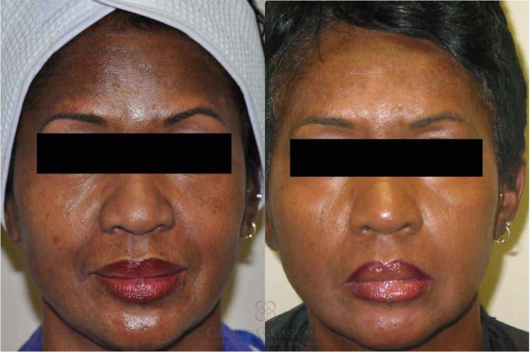 Before & After Melanage Peel Case 372 View #1 View in Houston, TX