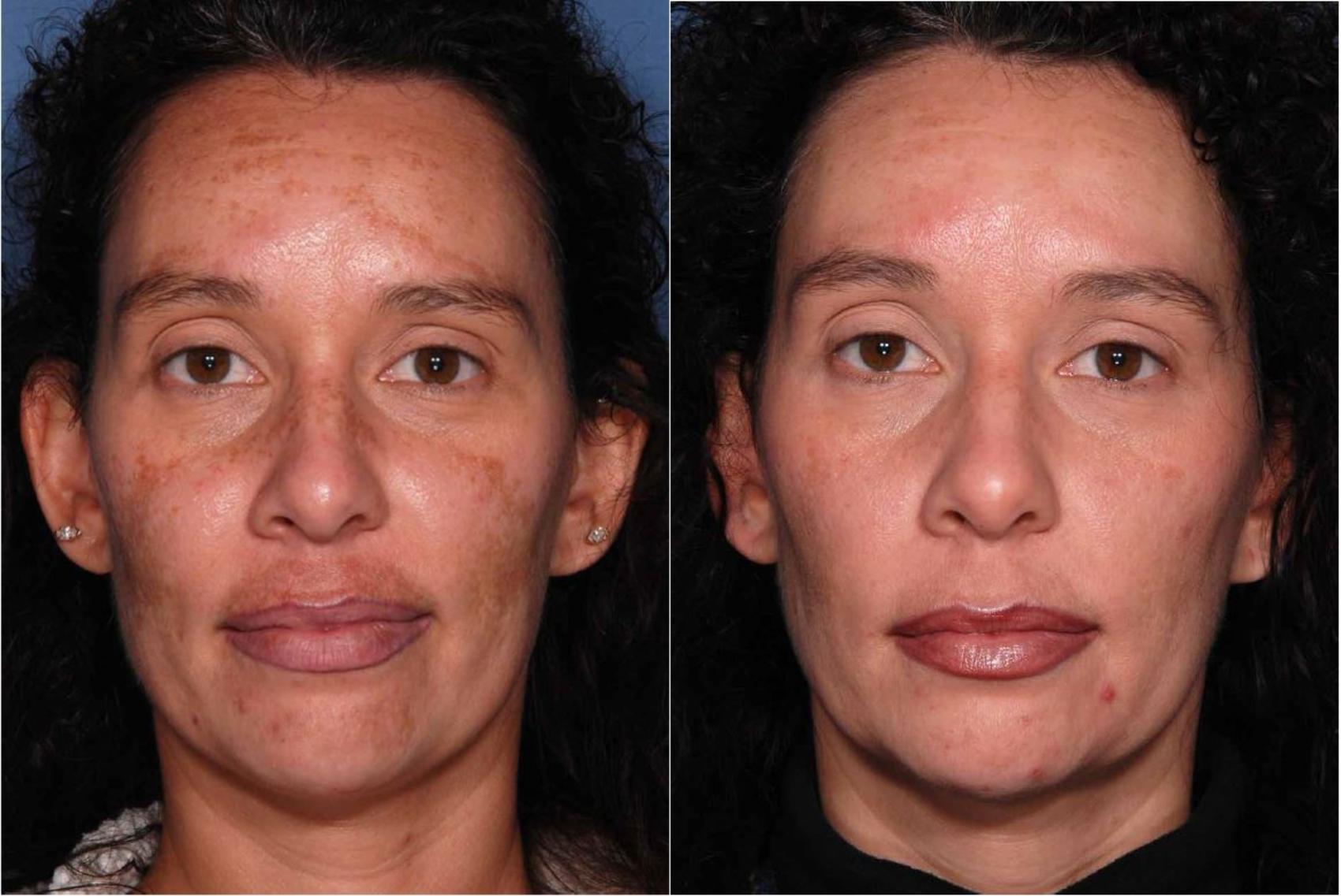 Before & After Melanage Peel Case 373 View #1 View in Houston, TX