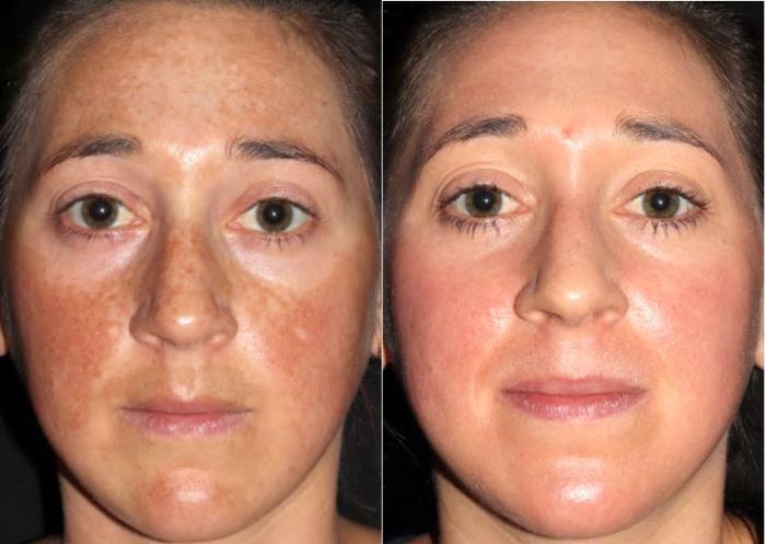 Before & After Melanage Peel Case 374 View #1 View in Houston, TX