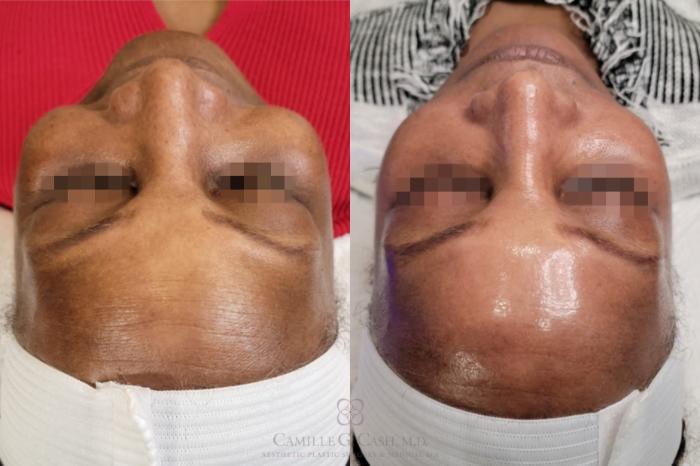 Before & After Chemical Peels Case 559 front aerial View in Houston, TX