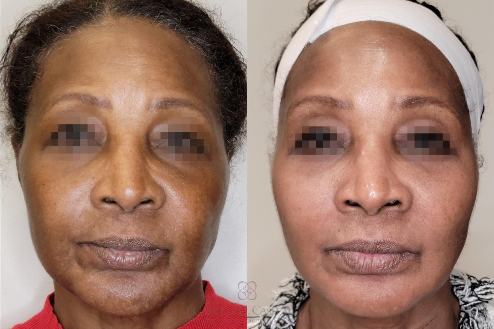 Before & After Melanage Peel Case 559 Front View in Houston, TX