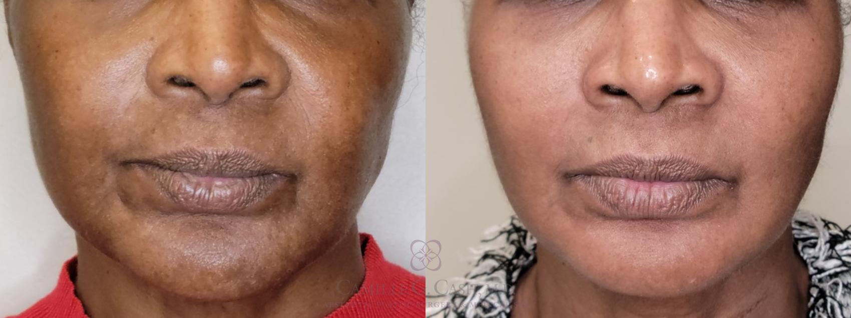 Before & After Chemical Peels Case 559 front lower face View in Houston, TX