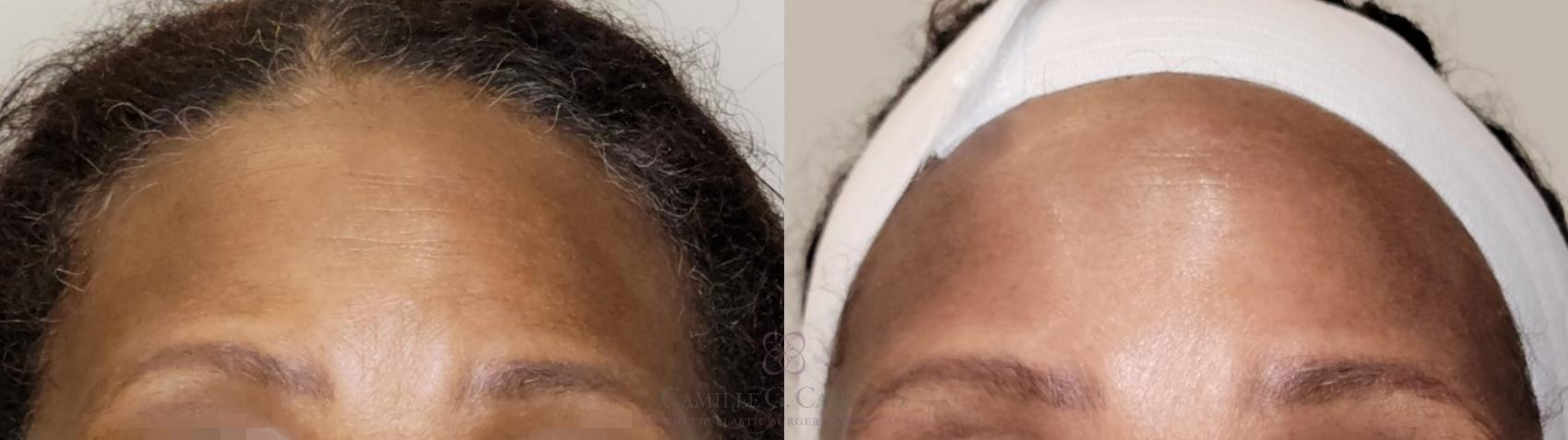 Before & After Chemical Peels Case 559 front upper View in Houston, TX