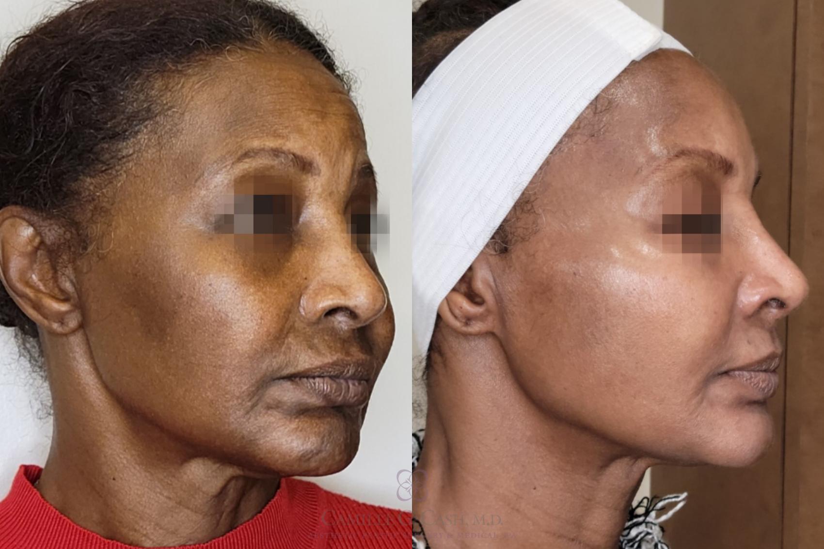 Before & After Chemical Peels Case 559 Left Oblique View in Houston, TX