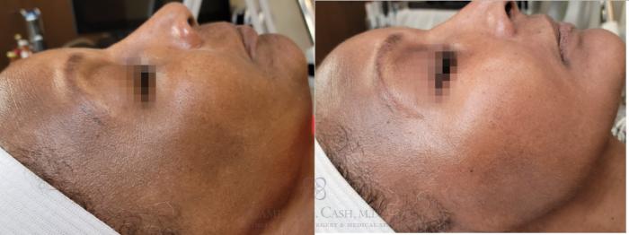 Before & After Chemical Peels Case 559 Left Side View in Houston, TX