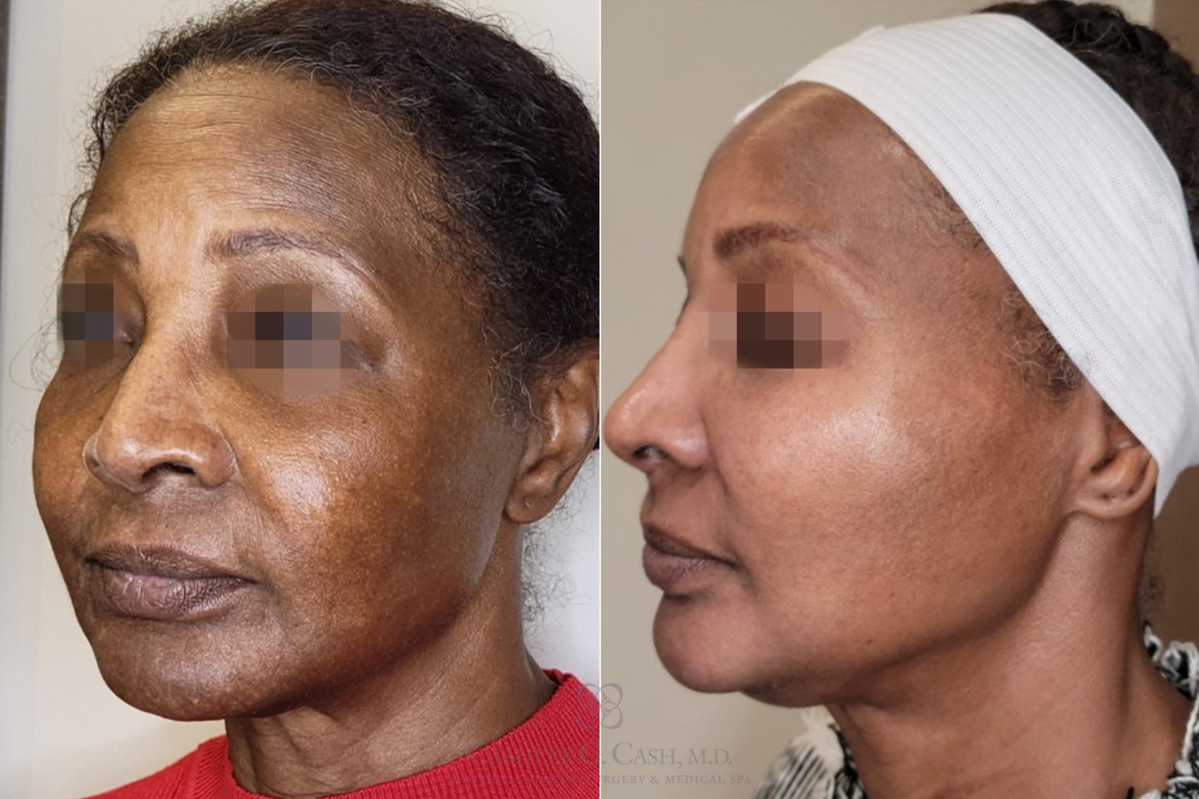Before & After Melanage Peel Case 559 Right Oblique View in Houston, TX