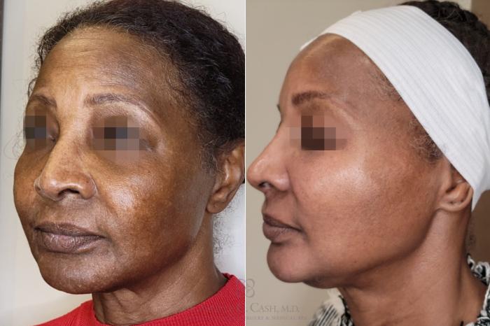 Before & After Chemical Peels Case 559 Right Oblique View in Houston, TX
