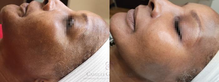 Before & After Chemical Peels Case 559 Right Side View in Houston, TX