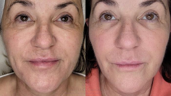 Before & After Melanage Peel Case 681 front close 2 View in Houston, TX