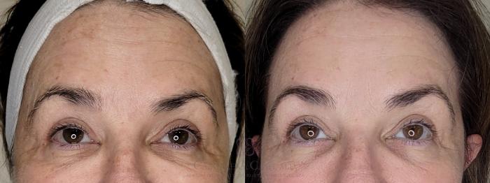 Before & After Melanage Peel Case 681 front close up 1 View in Houston, TX