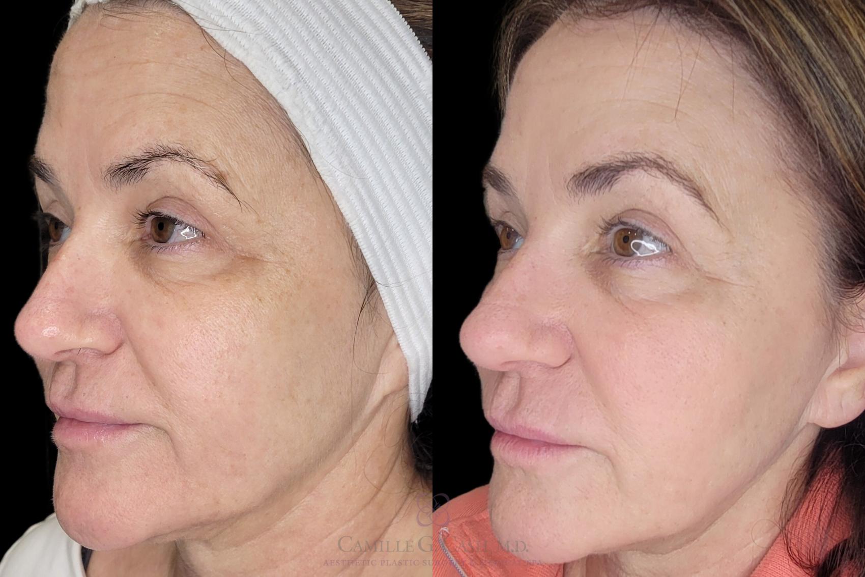 Before & After Melanage Peel Case 681 Left Oblique View in Houston, TX
