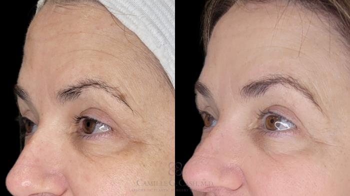 Before & After Melanage Peel Case 681 ob close up forehead View in Houston, TX