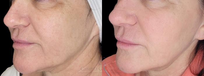 Before & After Melanage Peel Case 681 ob close up lower View in Houston, TX