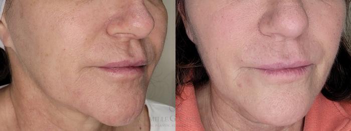 Before & After Melanage Peel Case 681 oblique close up 1 View in Houston, TX
