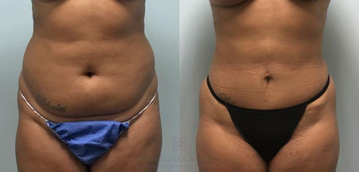 Before & After Liposuction Case 360 View #1 View in Houston, TX