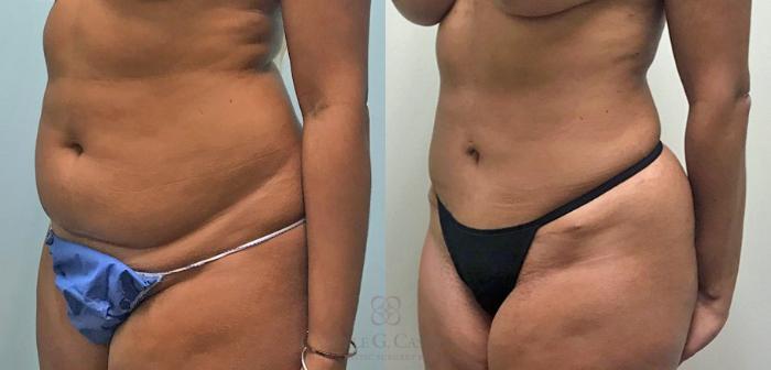 Mini Tummy Tuck performed by top Houston Plastic surgeon camille cash MD