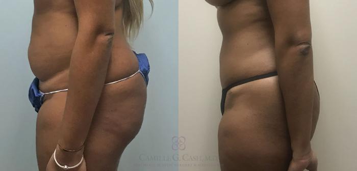 Before & After Mini Tummy Tuck Case 360 View #4 View in Houston, TX