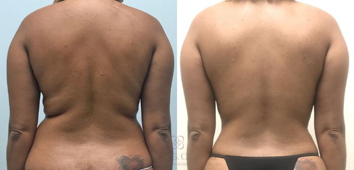 Before & After Liposuction Case 360 View #5 View in Houston, TX