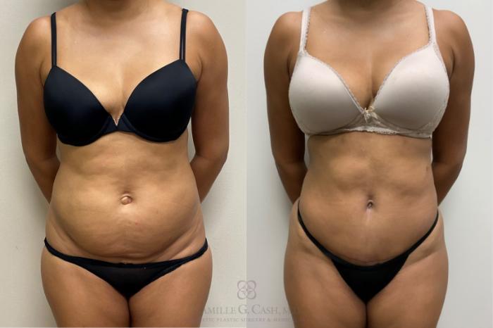 Before & After Tummy Tuck Case 379 View #1 View in Houston, TX