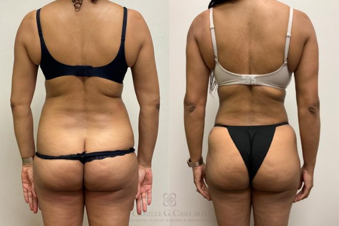 Before & After Tummy Tuck Case 379 View #2 View in Houston, TX