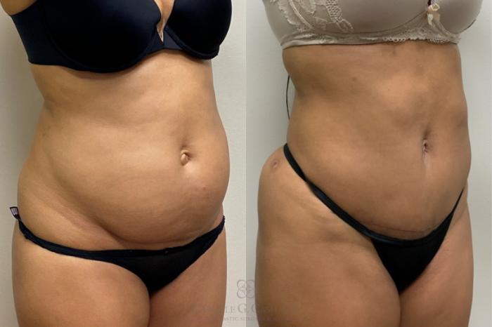 Before & After Mini Tummy Tuck Case 379 View #3 View in Houston, TX
