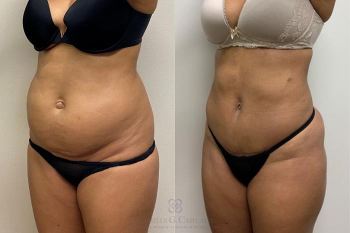 Before & After Liposuction Case 379 View #4 View in Houston, TX