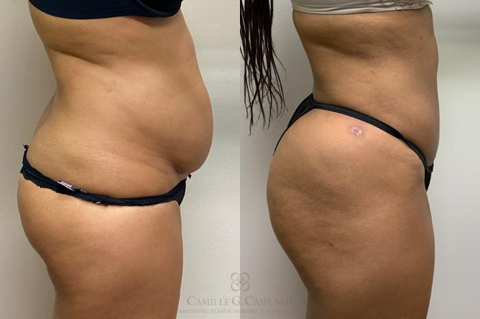 Before & After Liposuction Case 379 View #5 View in Houston, TX