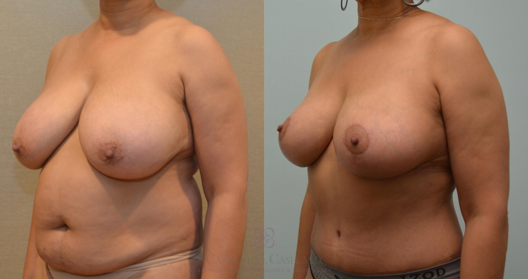 Before & After Mommy Makeover Case 129 View #5 View in Houston, TX